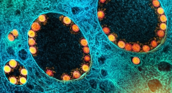 Mortes por covid-19 podem ser três vezes superiores a números oficiais